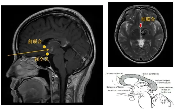 术后4个月文文恢复良好，肢体活动自如