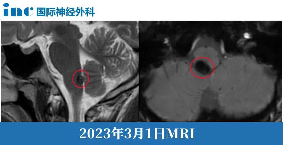 脑干海绵状血管瘤