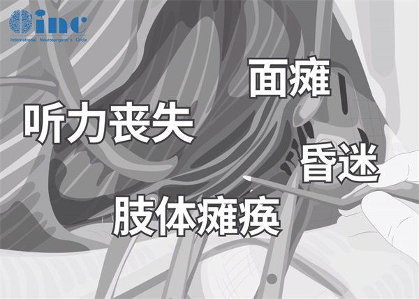 耳蜗神经瘤症状有哪些表现