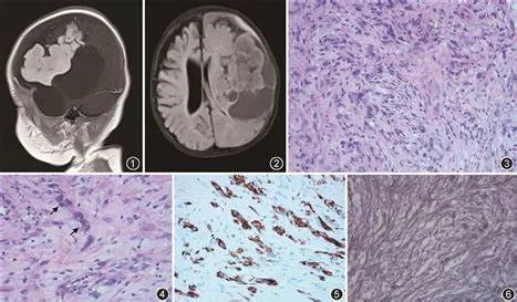 促纤维增生性婴儿节细胞胶质瘤，好发婴儿该如何治？
