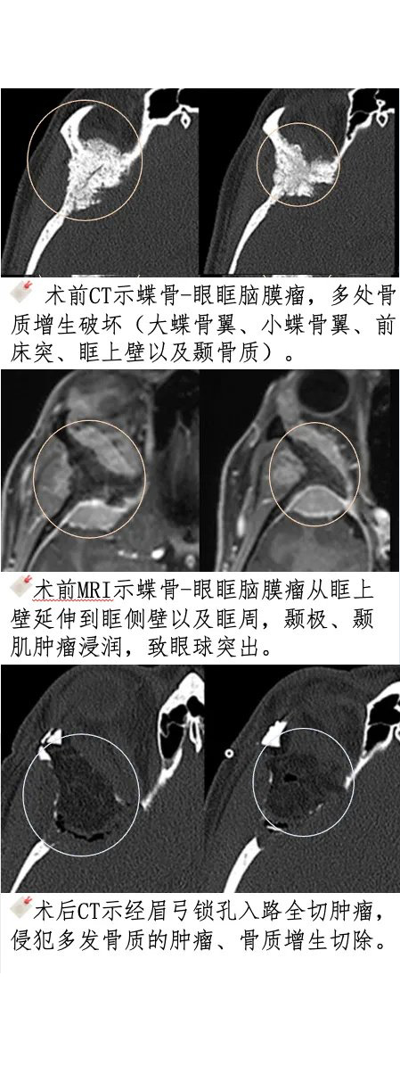 案例一：“经眉弓锁孔入路”全切蝶眶脑膜瘤
