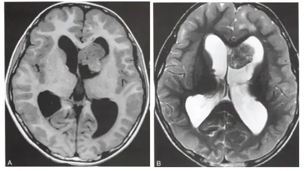 室管膜下巨细胞型星形细胞瘤