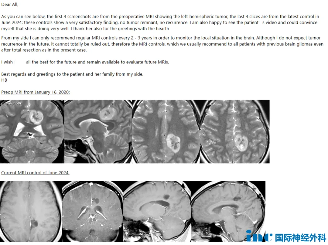 胶质瘤全切术后复发吗