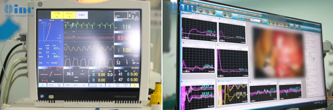 手术在术中神经电生理监测下进行