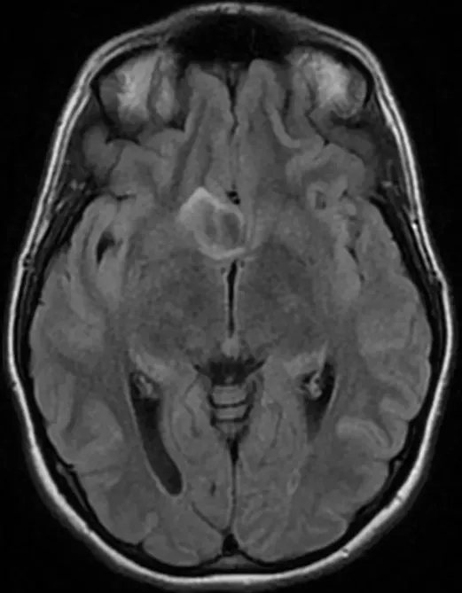 INC脑博士科普——黏液样胶质神经元肿瘤