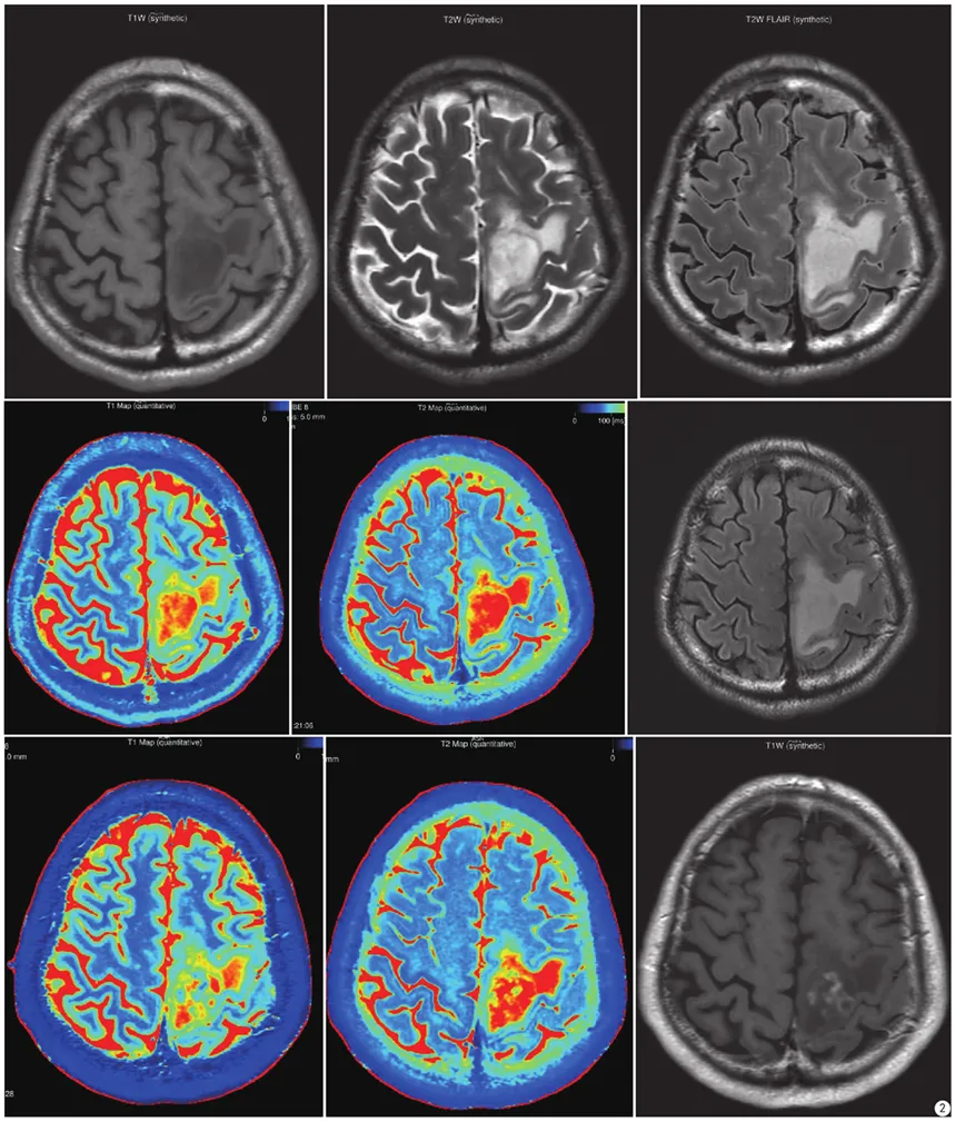 低级别胶质瘤。从左至右、从上到下分别是：合成图像（T1WI、T2WI、T2FLAIR)；合成T1 mapping、合成T2 mapping、常规扫描T2 FLAIR；增强后合成图像（T1 mapping+C、T2 mapping+C、T1WI+C)