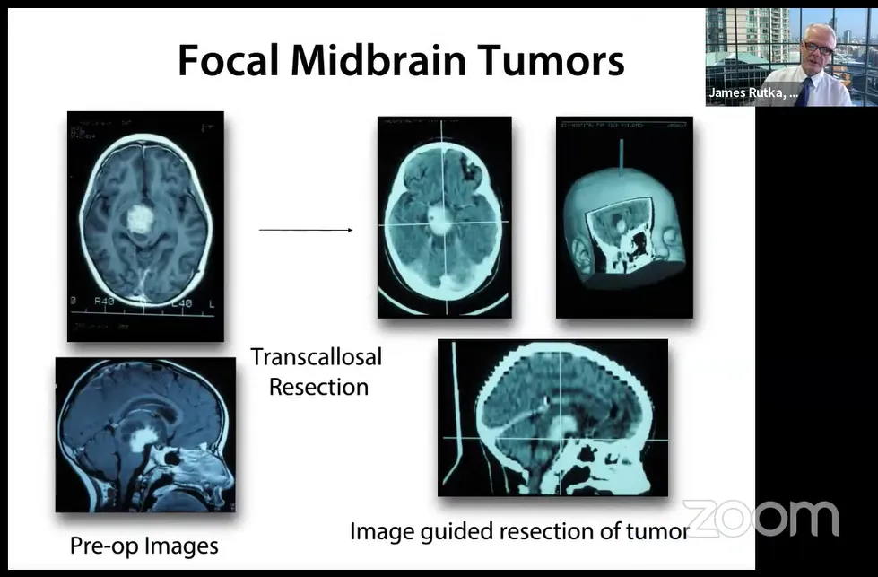 Transcallosal Resection：经胼胝体切除术，Pre-op Images：术前影像，Image guided resection of tumor：图像引导肿瘤切除术