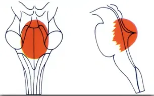 背侧外生型脑桥胶质瘤