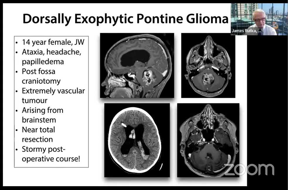 14岁女孩，出现共济失调、头痛、视乳头水肿。行后颅窝开颅术，近全切。