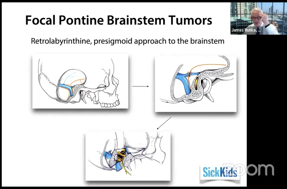 经迷路后、乙状窦前入路至脑干