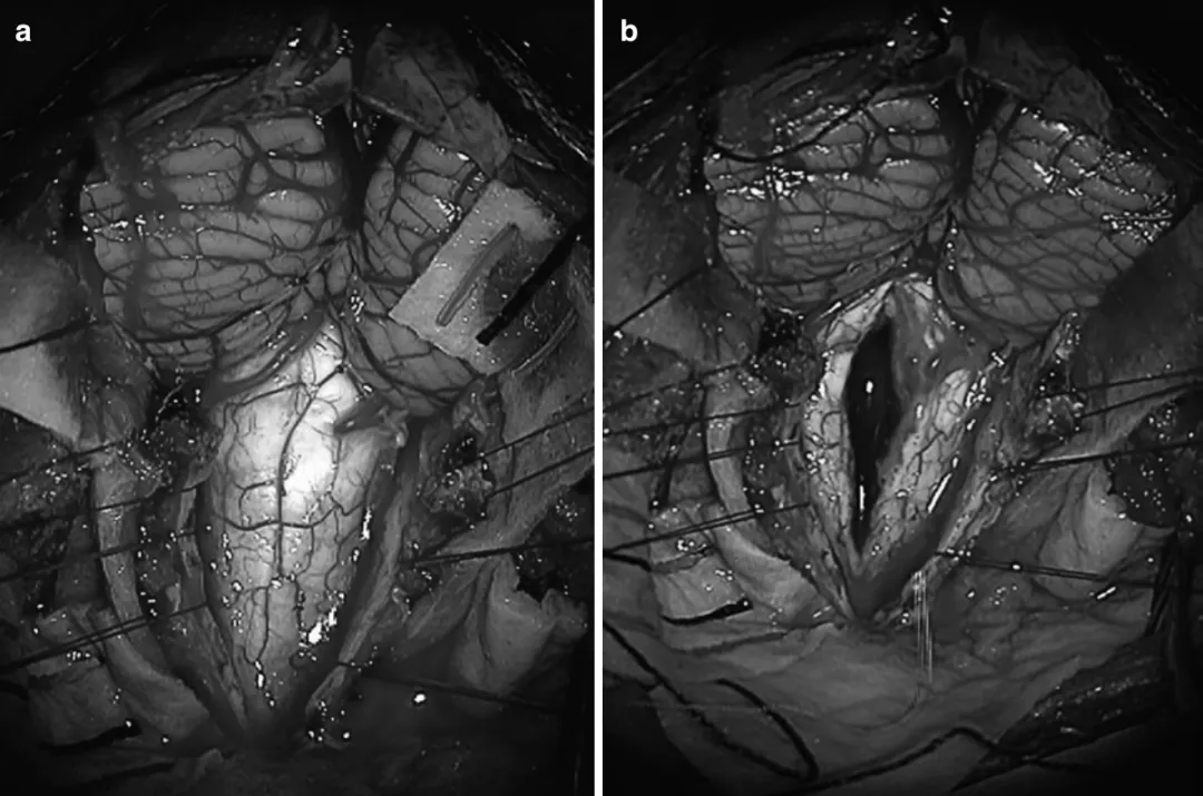 图：延髓-颈髓胶质瘤的术中照片图，（a）后颅窝开颅后，可见延髓-颈髓胶质瘤，在连续的术中神经电生理（IONM）监测下，使用CUSA超声刀切除了肿瘤。(b)显示肿瘤切除后的即时照片，显示脊髓后正中线切开和延髓-颈髓胶质瘤的切除。