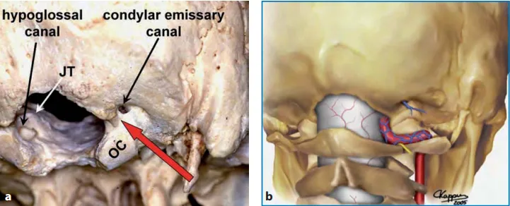 图：枕骨大孔区，从右背外侧和下角观察颅骨（a）和右背外侧颅骨区图示（b）。如大箭头所示，枕骨大孔前缘和神经轴前表面的直线视图被枕骨大孔外侧缘、髁状突后导管和寰枕关节内侧部分阻挡。通过部分磨除椎动脉硬脑膜入口正外侧的骨质结构，可以充分扩大手术视角，以便安全地操作神经轴的前外侧。OC：枕髁，JT：颈静脉结节。