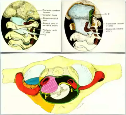 图：巴特朗菲教授及其导师Seeger教授共同绘制，从背外侧、枕下、经髁入路到下斜坡和颅颈交界处的前部。图自Neurosurgery 29：815-8211991