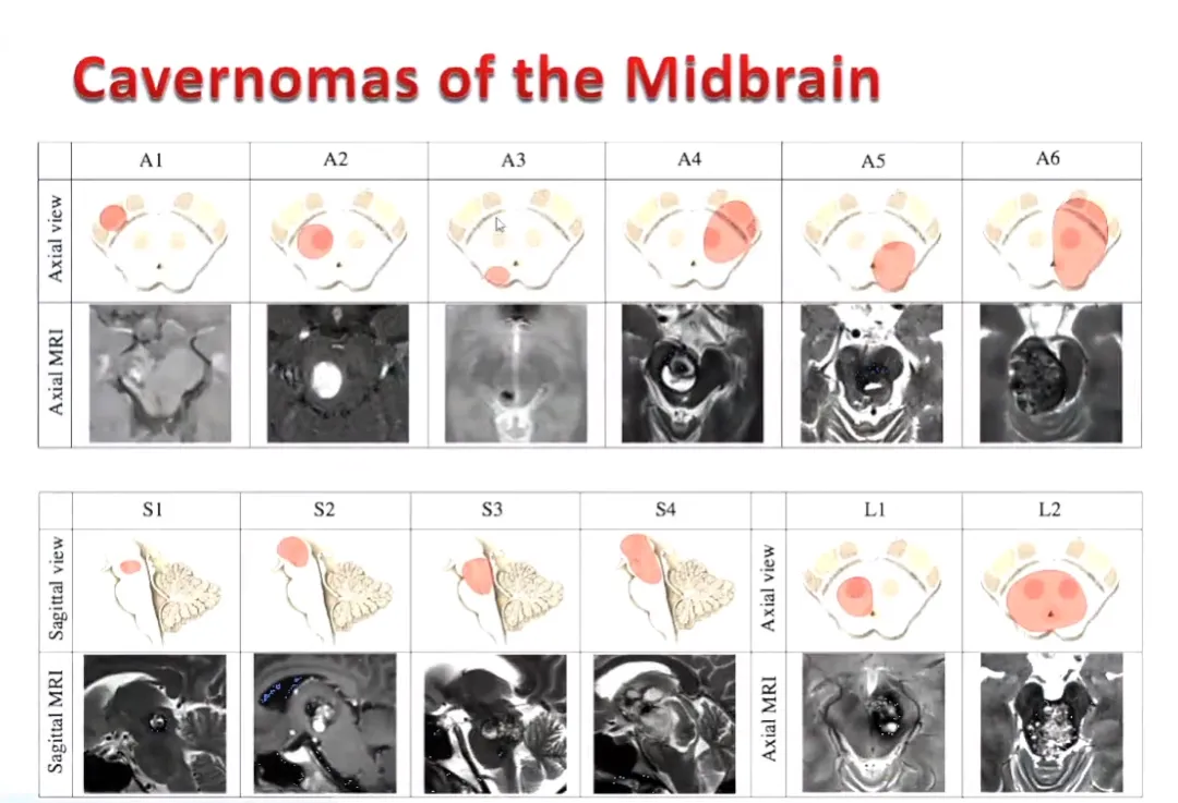 病变延伸的区域是向上还是向下，还要看是单侧还是双侧的病变。在巴特朗菲教授这篇对于72例中脑海绵状血管瘤病例的报告中，根据在轴向平面上看到的位置，大概可以分为以下几类：仅中脑角（A1），仅被盖（A2），仅顶盖（A3），脑角和被盖（A4），被盖和顶盖（A5），和所有3个区域（A6），包括中脑脚，被盖和顶盖（下图）。