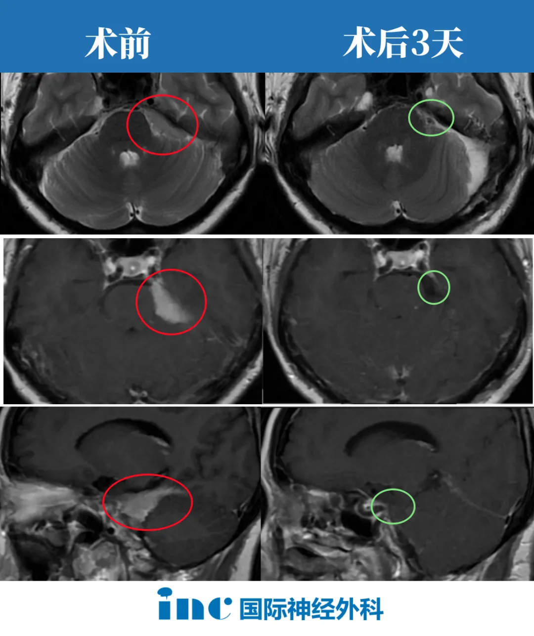 苏州大学医院手术室外,结束手术后的巴教授第一时间内将这个好消息告诉了一直守护在外的方女士家人