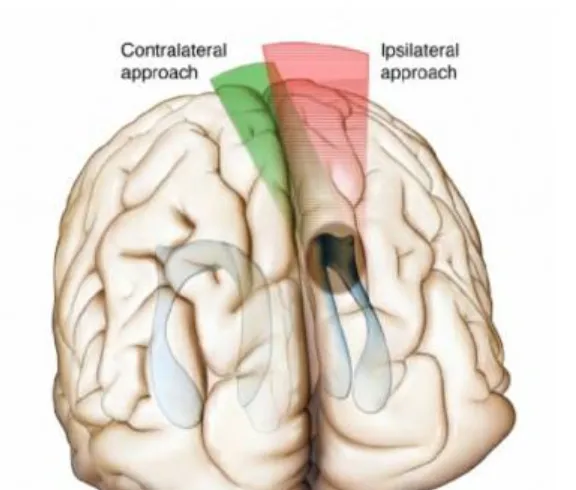 对于向侧方发展的病变来说，对侧经大脑镰“斜线”通道（绿色区域）提供了更加灵活的工作角度。在显露肿瘤侧方边界时，这种针对经同侧纵裂路径的改良，减少了对同侧大脑半球的牵拉（红色区域）。（Contralateral approach:对侧入路；Ipsilateral approach:同侧入路）