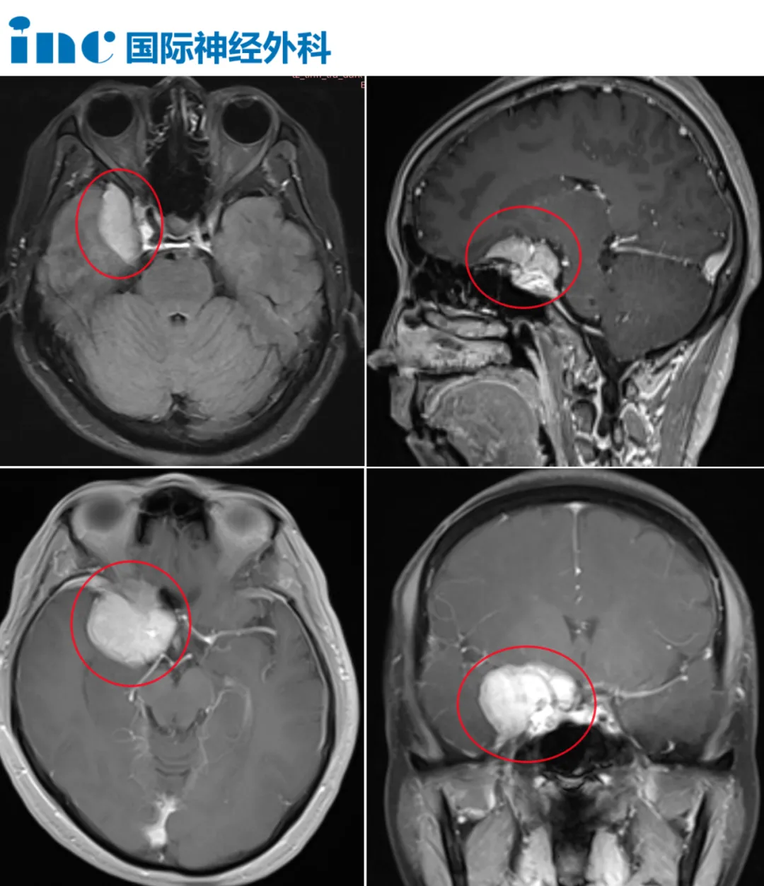 57岁女性-多发脑膜瘤+脑干海绵状血管瘤