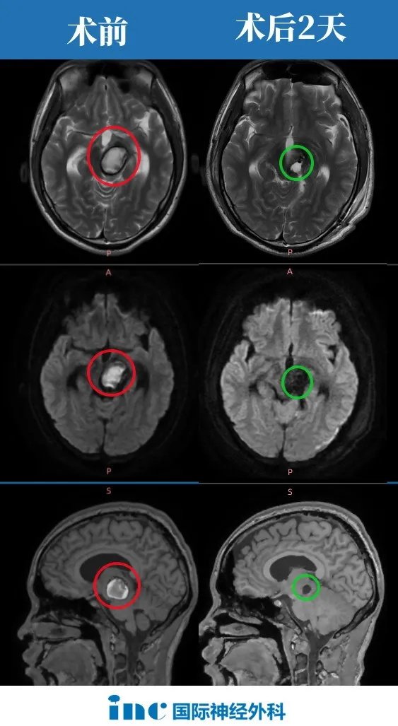据术中神经电生理医生的反馈——小林的病灶切完之后运动神经的反应明显好转。