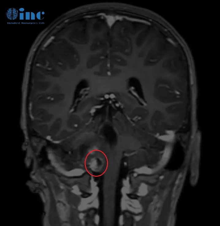 “不能等!趁着目前还没有出现更严重的症状必须尽早手术”