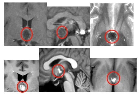 浩然第一次检查影像MRI