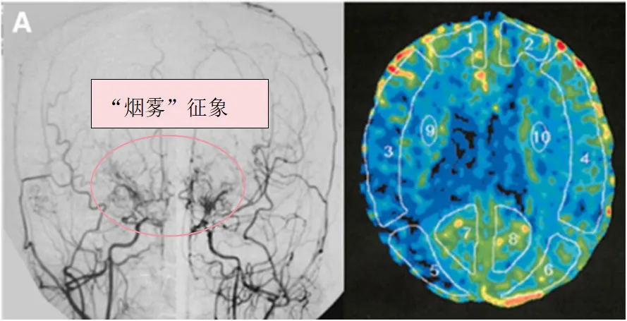 图1A：术前血管造影(双侧颈总动脉正位图)显示双侧颈内动脉末端有“烟雾血管狭窄征象”，双侧大脑中动脉(MCA)狭窄(左)。术前Xe-CT显示双侧MCA区域脑血流减少(右)