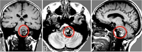 “潜伏的炸弹”—颅内未破裂动脉瘤，INC国际“拆弹专家”化解危机