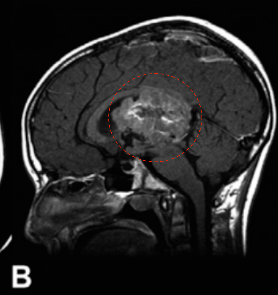 （B & C）磁共振成像显示一个可能起源于透明隔的异质性强化肿瘤，填充在侧脑室和第三脑室的大部分区域。