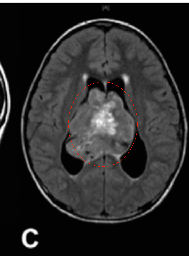 （B & C）磁共振成像显示一个可能起源于透明隔的异质性强化肿瘤，填充在侧脑室和第三脑室的大部分区域。