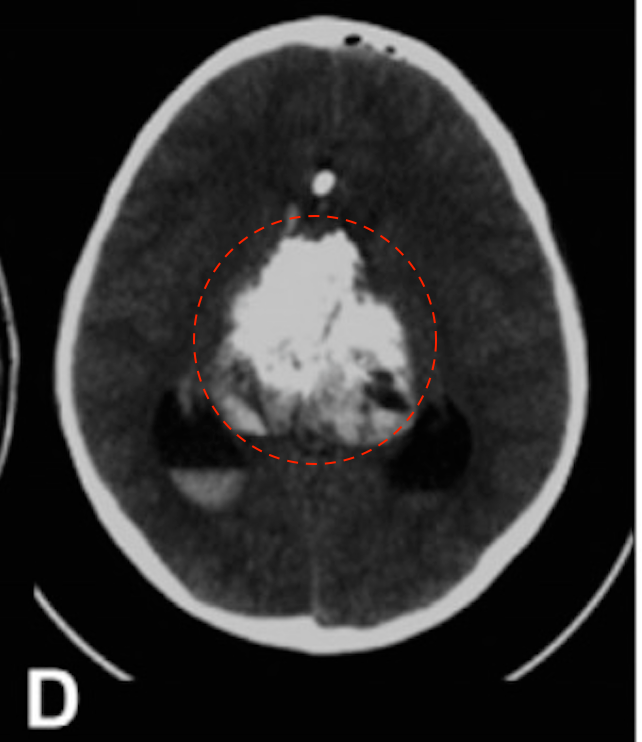 (D)尝试左额半球间经胼胝体切除术后的CT扫描显示脑室内和腔内内出血。