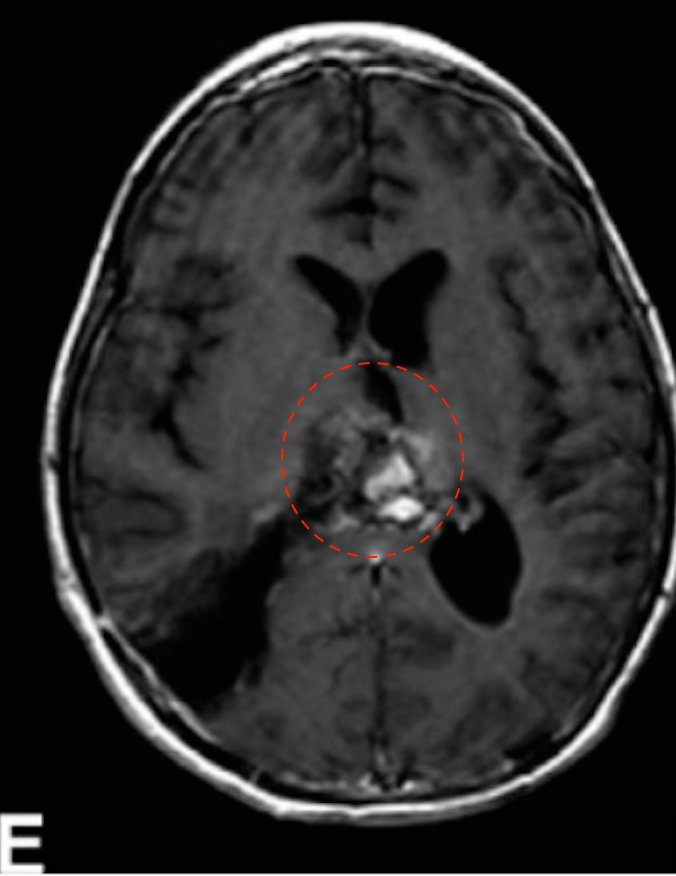 (E)第二次手术，经右顶叶经皮质入路行次全切除术，术后T1增强MRI为WHO 2级室管膜瘤，病人进行局部放疗。