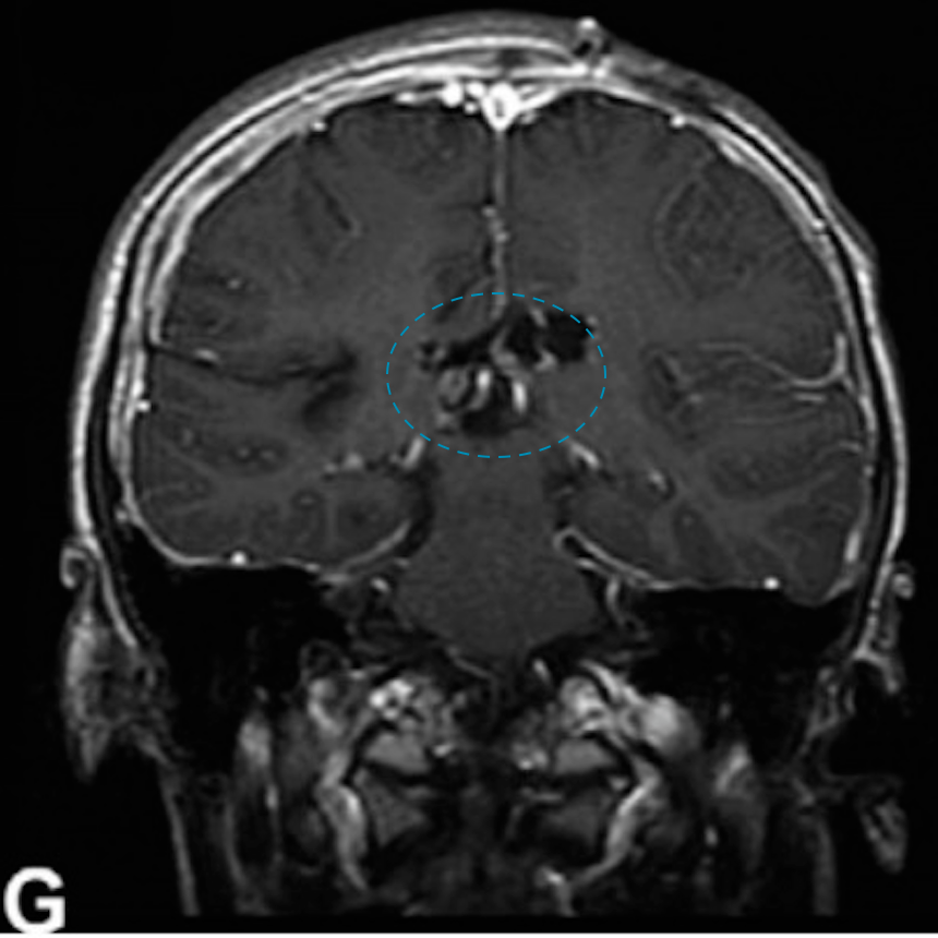 （G）随访图像显示6年后病情稳定。
