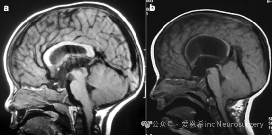 两张矢状位 T1 磁共振成像（MRI）显示三脑室脑积水及小脑扁桃体轻度下移的类似图像。然而，在 a 图中，小脑容纳于正常的后颅窝（PCF）内，尽管其脑积水的严重程度低于 b 图，但仍可推测脑积水（导水管狭窄）在此情况下导致了小脑扁桃体下疝（CIM）。相反，在 b 图中，小脑位于较小的后颅窝内（观察穹窿向上疝出，伴 Galen 静脉系统移位），且导水管通畅；因此，很可能在这种情况下 CIM 导致了脑积水。