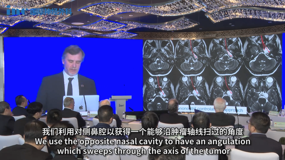 福教授采用对侧单鼻孔入路以获得沿肿瘤轴线的最佳操作角度。他在鼻中隔单侧作小切口后将鼻中隔推至对侧，随后精确磨除蝶窦前壁及底部。