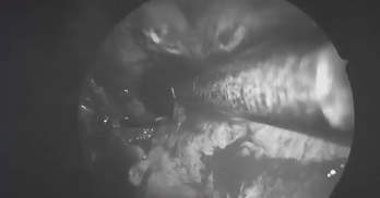 通过对侧翼管神经和蝶翼缝的解剖定位，福教授准确找到破裂孔段，进而到达斜坡旁区域。