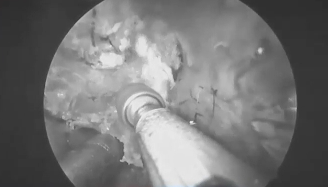 通过对侧翼管神经和蝶翼缝的解剖定位，福教授准确找到破裂孔段，进而到达斜坡旁区域。