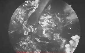 此时手术已接近最后阶段，通过向内侧和下方探查即可最终显露肿瘤。在完全暴露肿瘤后，福教授继续精细磨除斜坡内侧部分骨质。