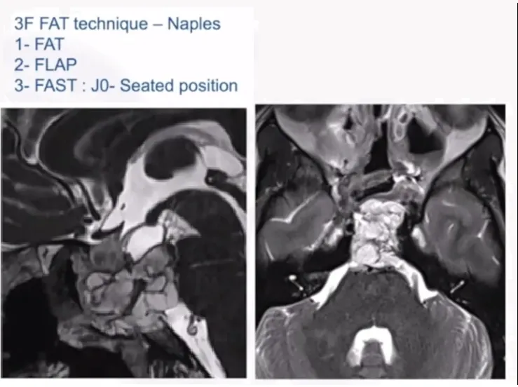 在处理该问题时，福教授采取了多种技术手段，涵盖了多层复合技术（Multilayer）和垫圈密封技术（Gasket-seal），并辅以缝合线（Sutures）及各类生物源性材料。在多数病例中，福教授倾向于采用脂肪填充的鼻中隔皮瓣进行修复。