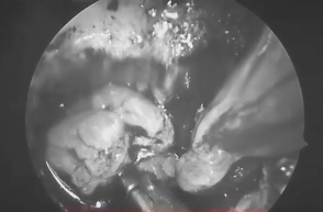 手术结束时，福教授会在肿瘤腔内放入一些脂肪和胶水，然后进行缝合。