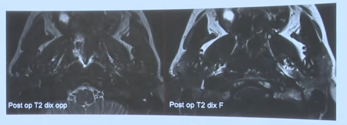术后的核磁影像