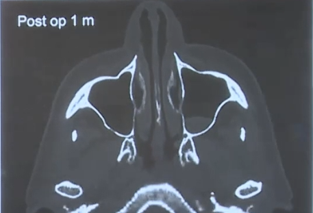 这是术后一个月后，鼻子完好无损，唯一的变化是蝶窦现在是颅腔的一部分。