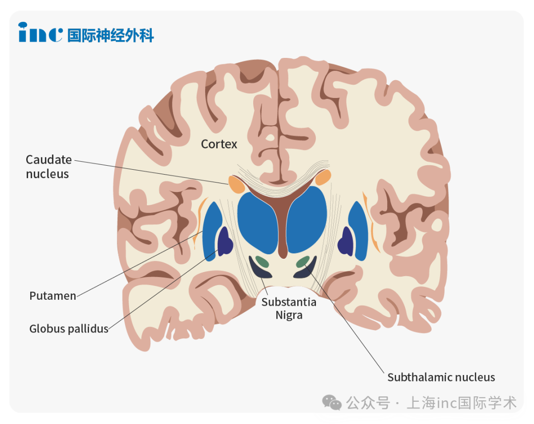 脑部健康密码：基底节海绵状血管瘤解读