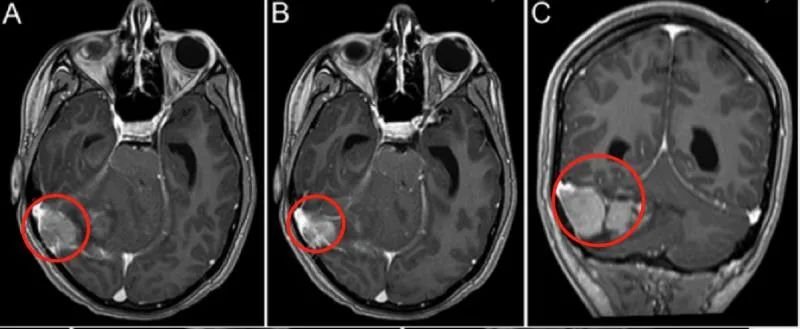 核磁扫描结果显示，Anita右侧小脑半球存在 5.6×5.0×3.4 cm的高信号巨大占位，且肿瘤已经压迫第四脑室，伴发梗阻性脑积水。