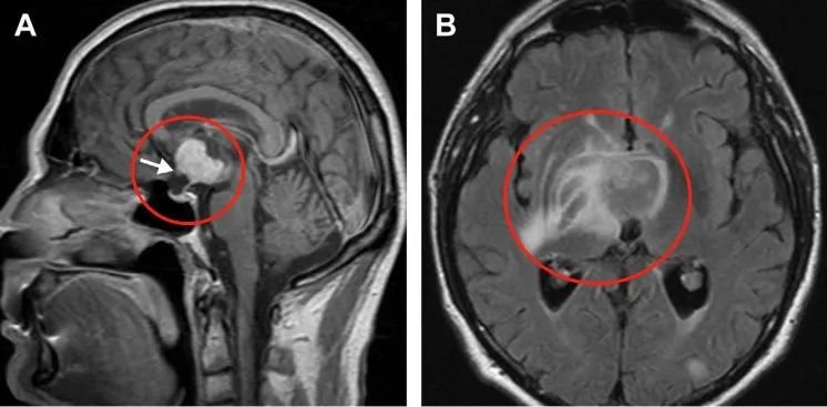 鞍上增强MRI显示，颅咽管瘤延伸至第三脑室，有实性成分(a)。视神经交叉前移(箭头标记)，垂体和蝶鞍形态正常。病灶向右侧基底节区外侧延伸，且周围水肿，具有下丘脑侵犯征象。