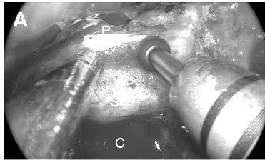蝶鞍底及蝶面骨质磨除