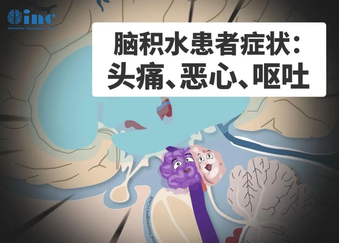 脑积水患者症状