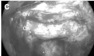 硬脑膜暴露及重要结构识别