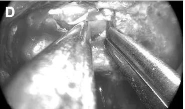 鞍上间隙硬脑膜开口