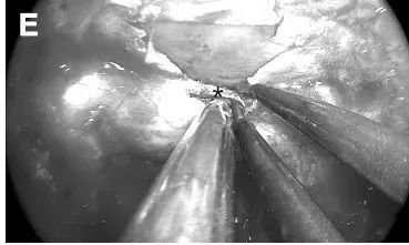 海绵窦内上方电凝处理