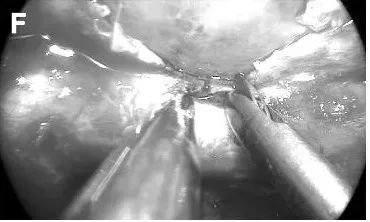 海绵窦内上方充分暴露