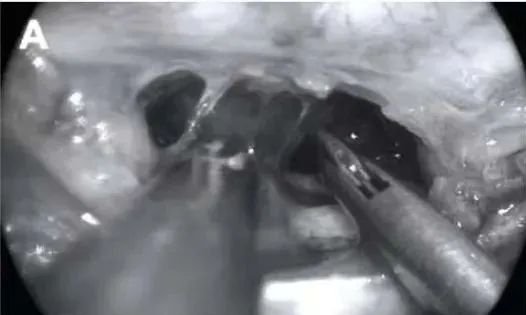 蛛网膜锐性分离